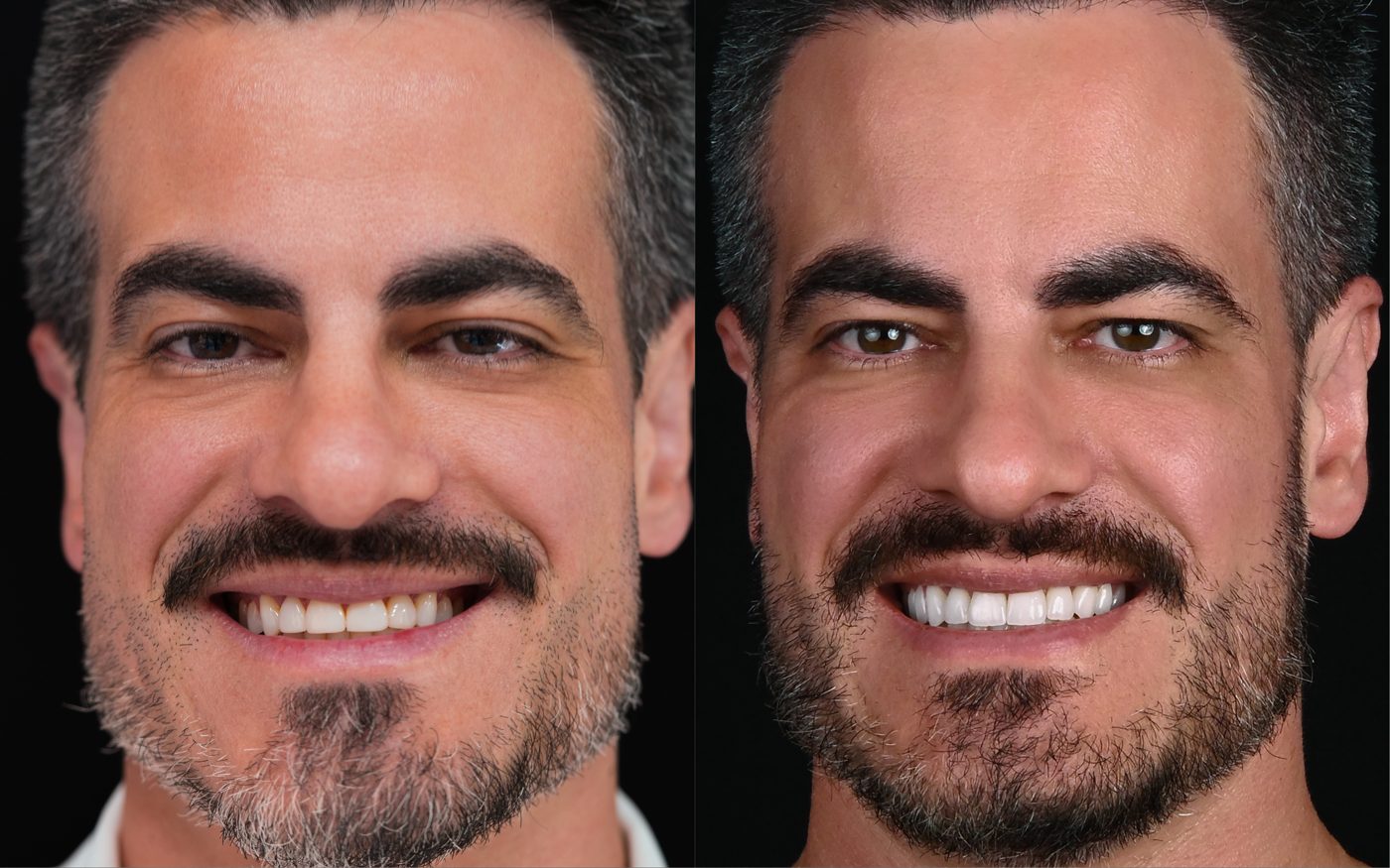 Comparativo antes e depois do sorriso