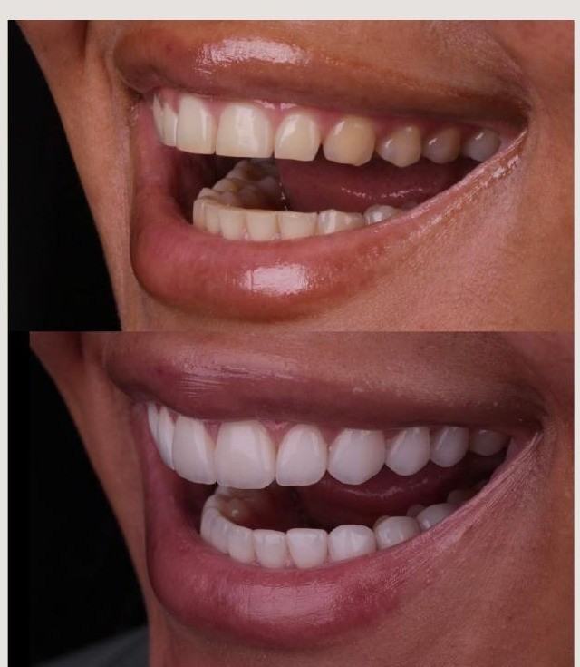 Caso 1 — antes e depois Sorriso L'avance