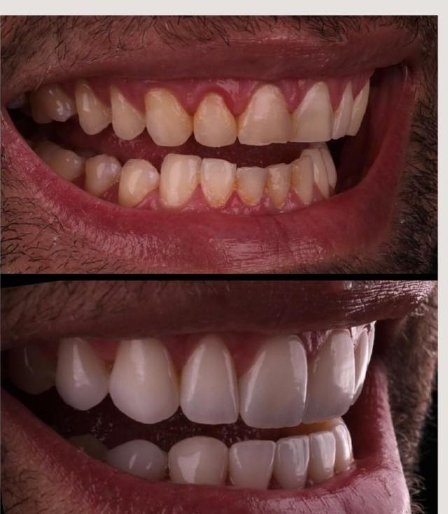 Caso 2 — antes e depois Sorriso L'avance