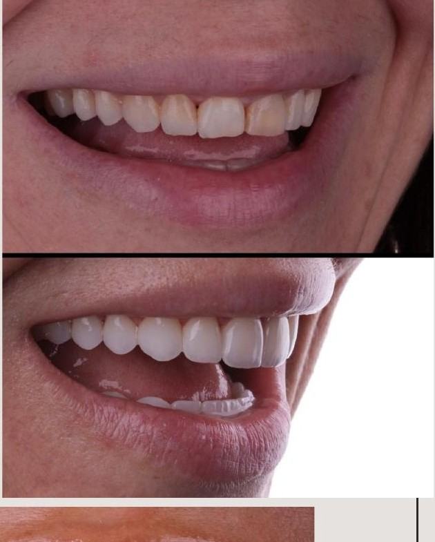 Caso 4 — antes e depois Sorriso L'avance