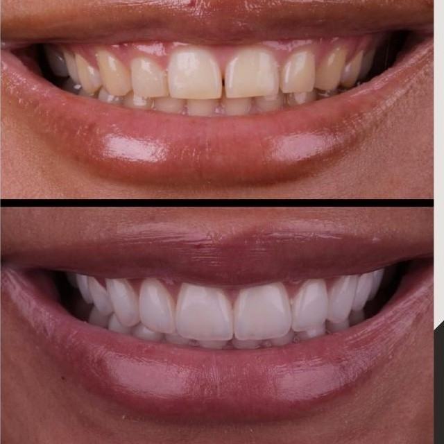 Caso 6 — antes e depois Sorriso L'avance