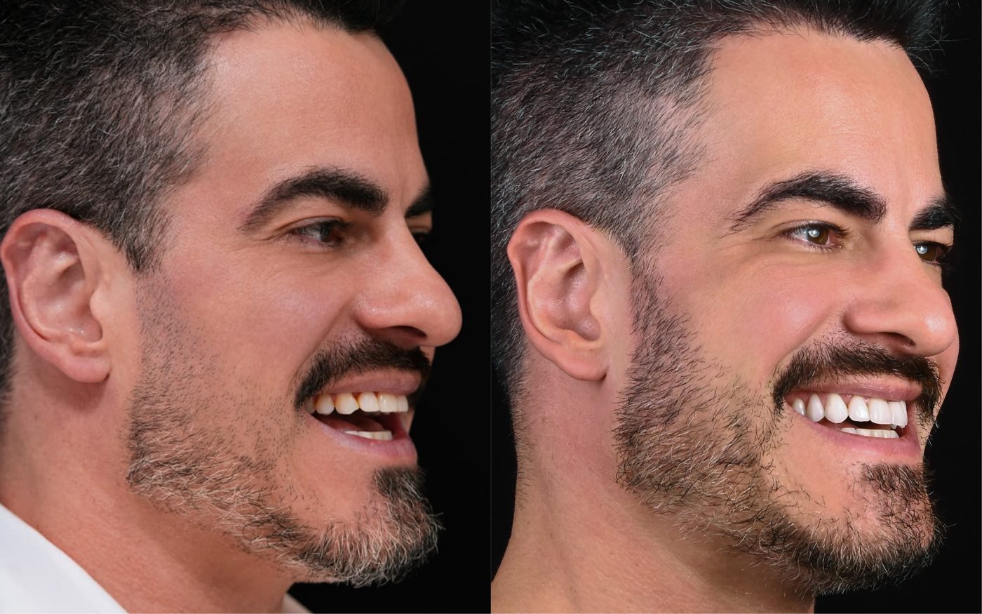Antes e depois de paciente do Sorriso L'avance