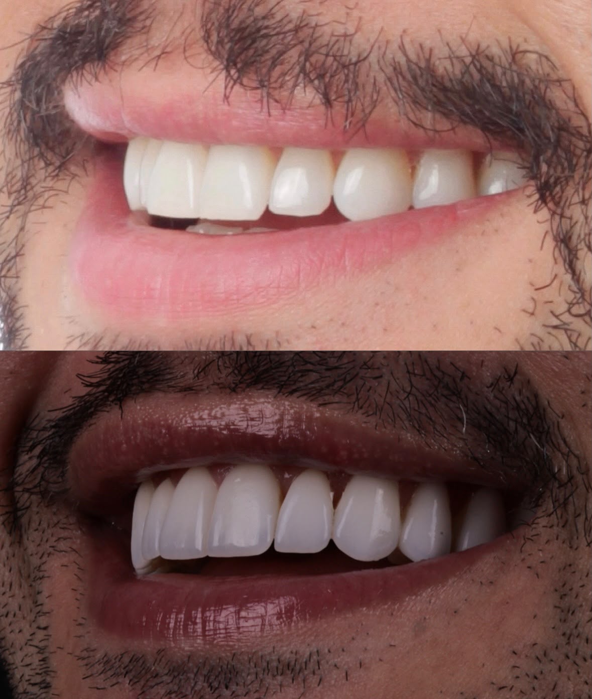Antes e depois em close das lentes de contato dentais do Thiago