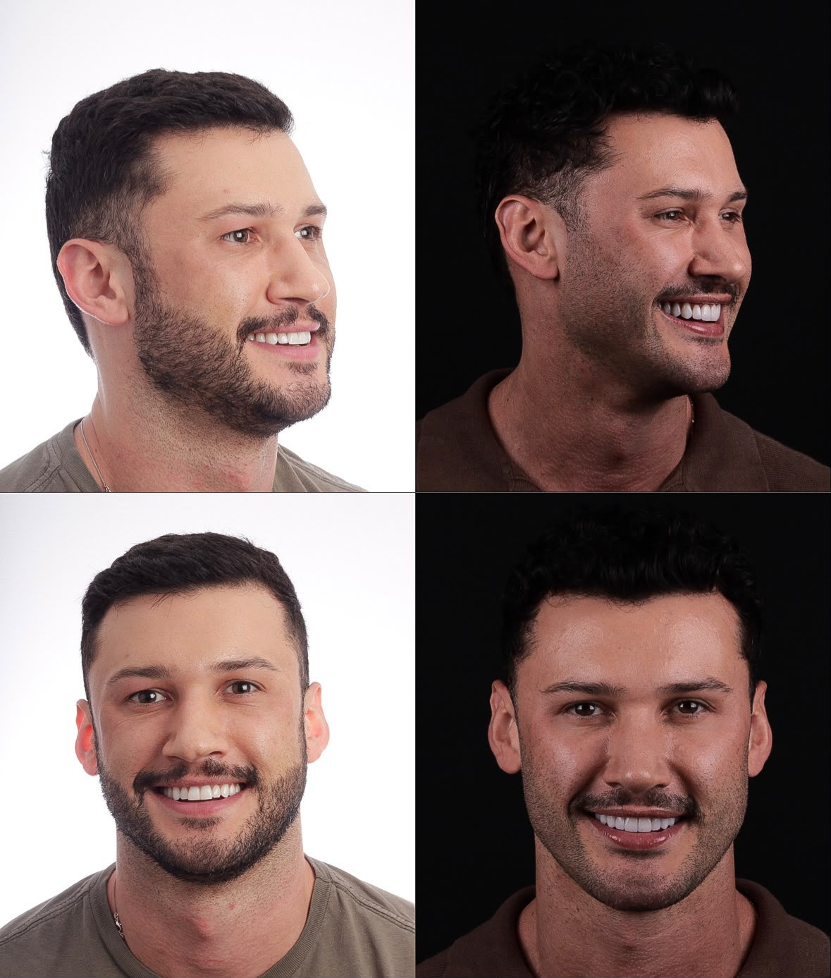 Antes e depois do sorriso do Thiago — perfil e frontal